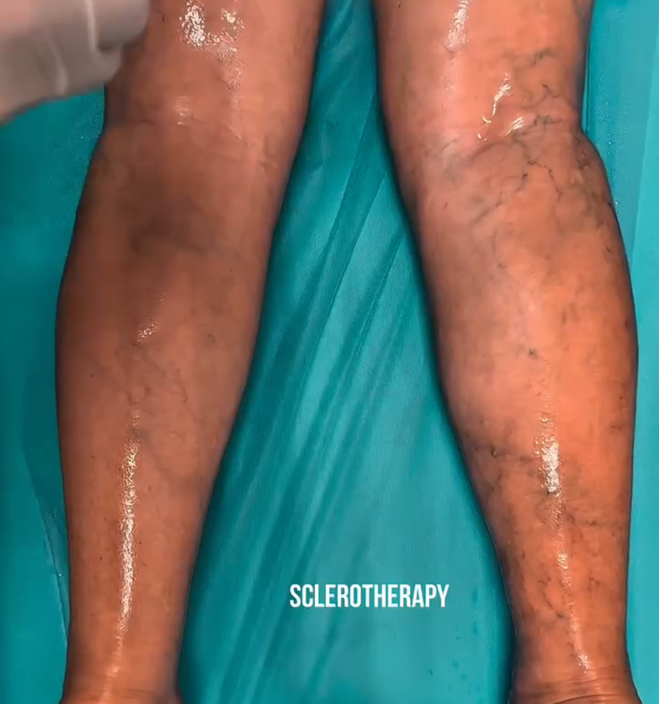 Склеротерапия, или Как избавиться от варикоза?